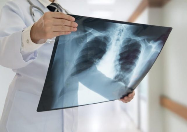 Health Bureau launches Macau’s lung cancer screening scheme today