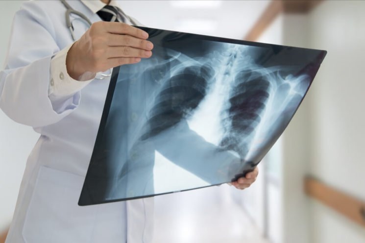 Health Bureau launches Macau’s lung cancer screening scheme today