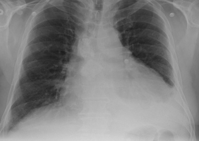 Deadly Legionnaires’ disease strikes again